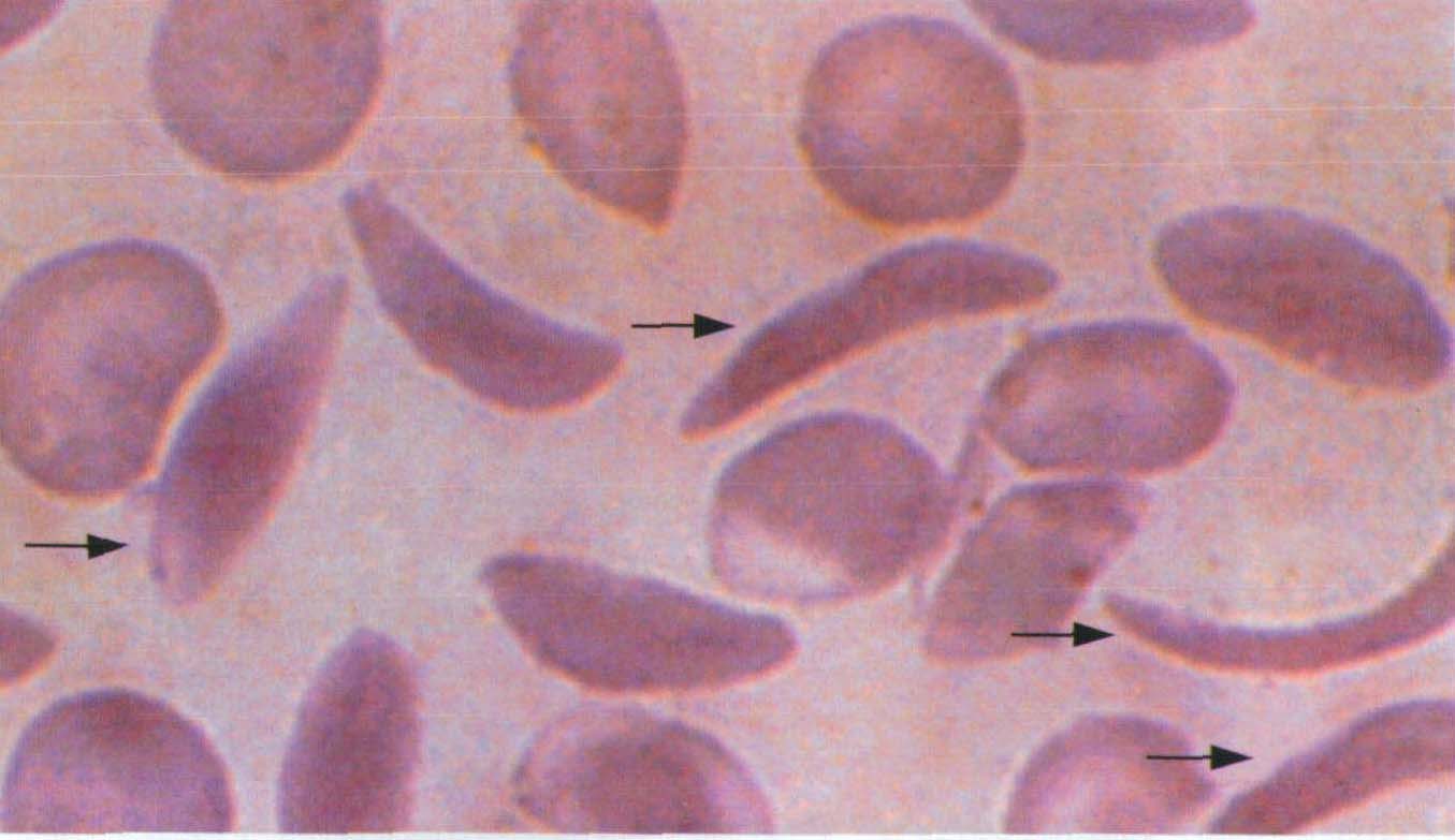 图7 镰状红细胞